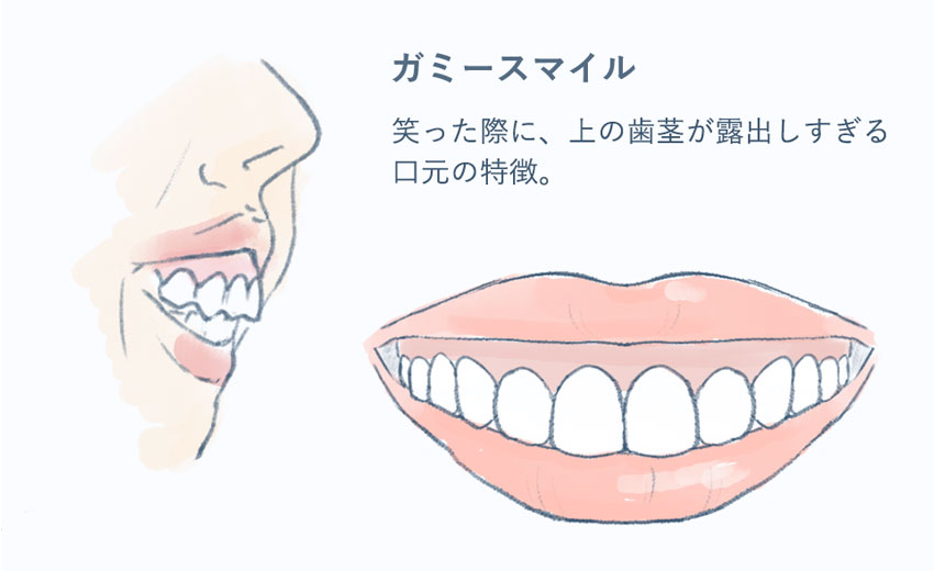 ガミースマイルとは