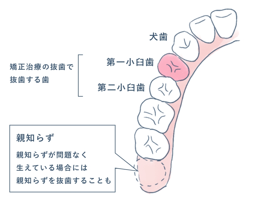 矯正治療での抜歯
