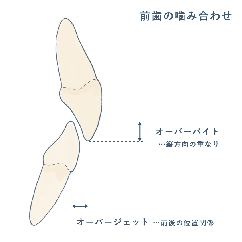 オーバーバイトとオーバージェット