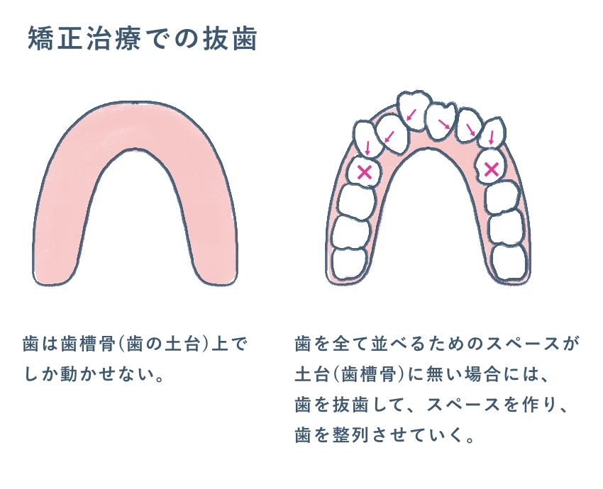 抜歯が必要な例