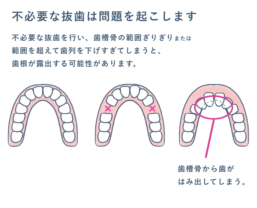 不必要な抜歯の問題