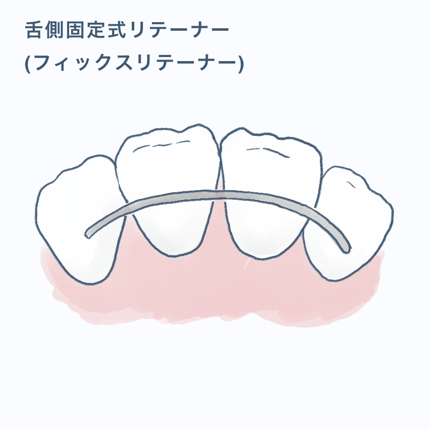 舌側固定式リテーナー(フィックスリテーナー)