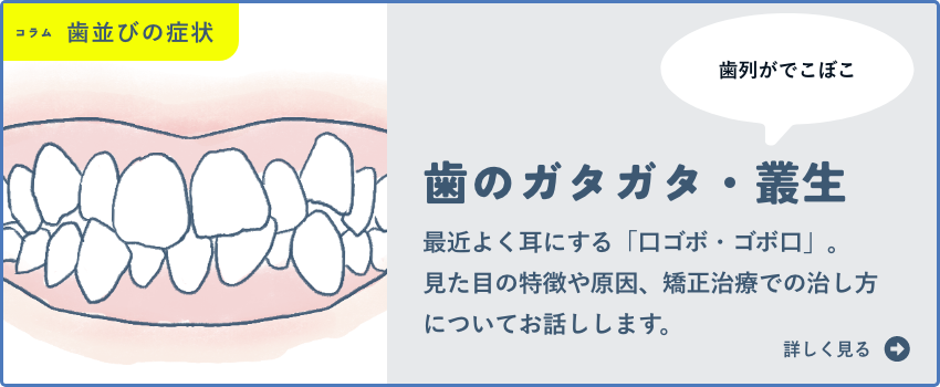 歯のガタガタ・叢生の矯正