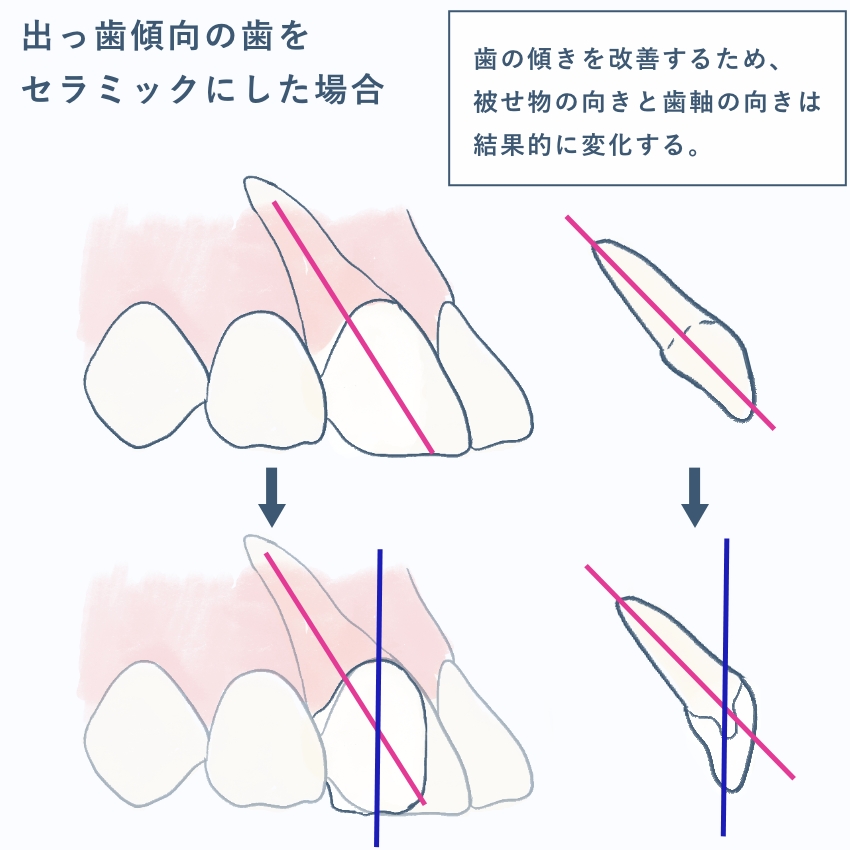 セラミック