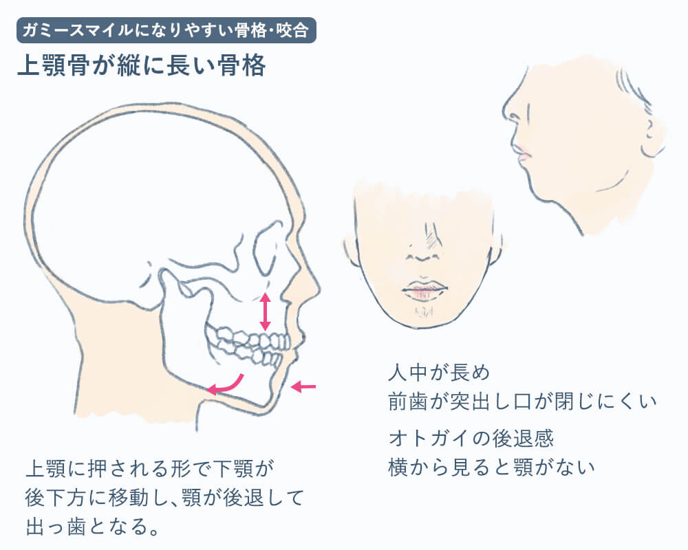 上顎骨の長さが原因のガミースマイル