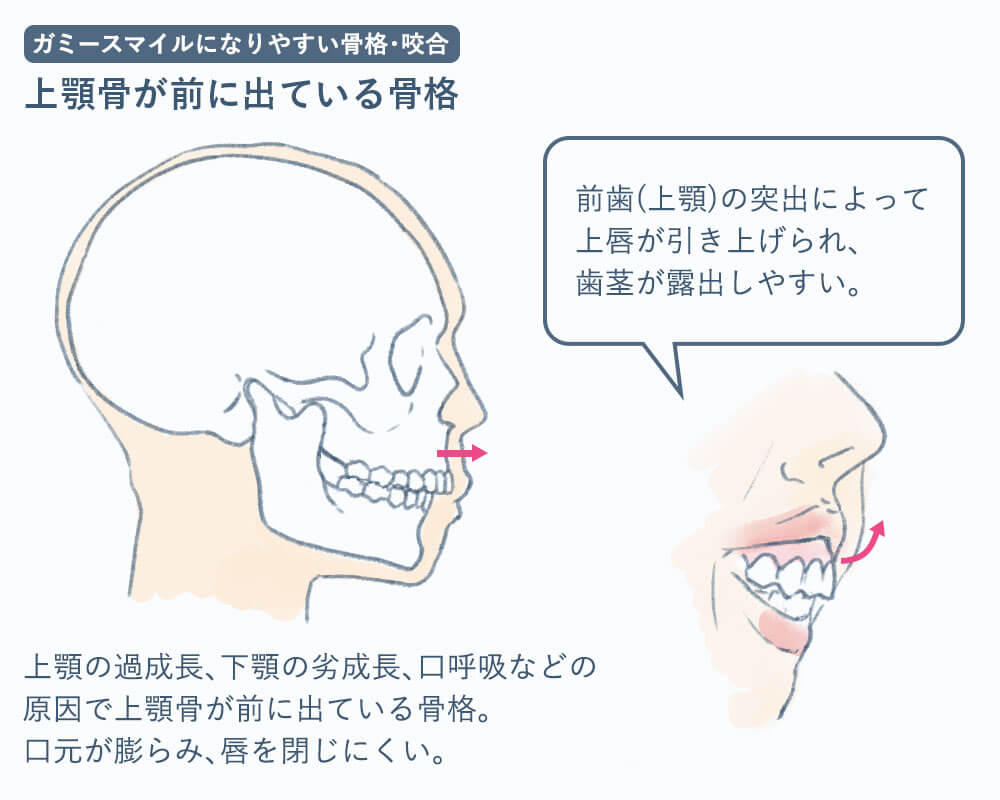 上顎骨の長さが原因のガミースマイル
