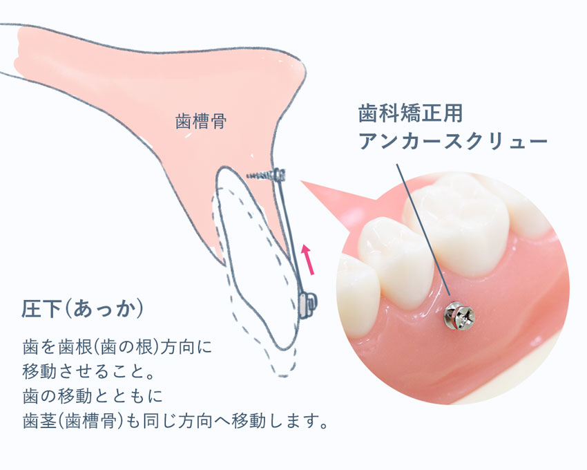 ガミースマイルの矯正