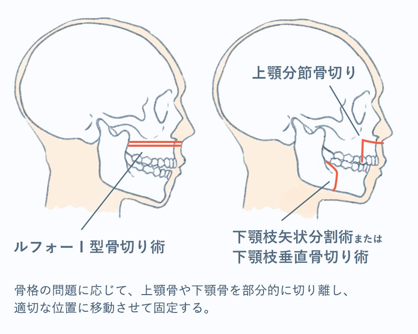 外科矯正＋歯列矯正