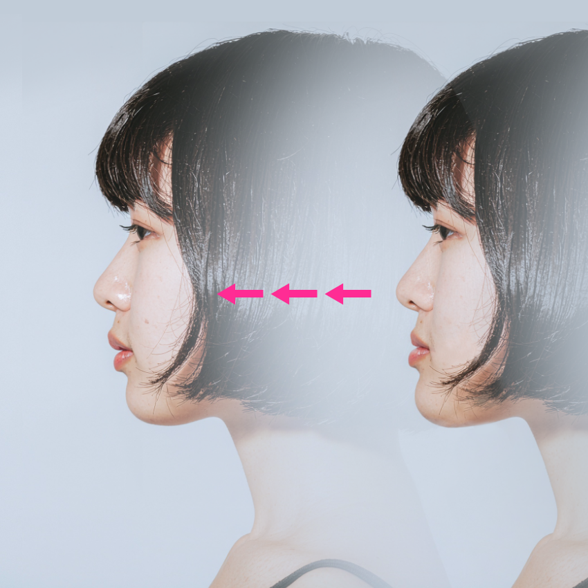外科矯正のシミュレーション