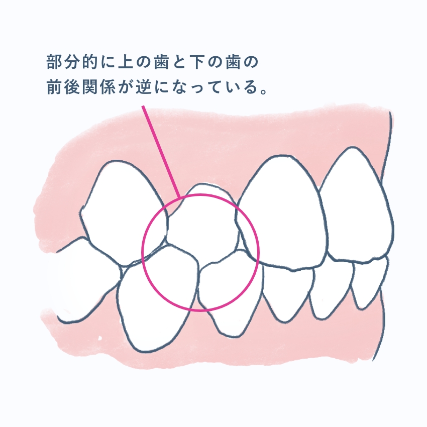 クロスバイト