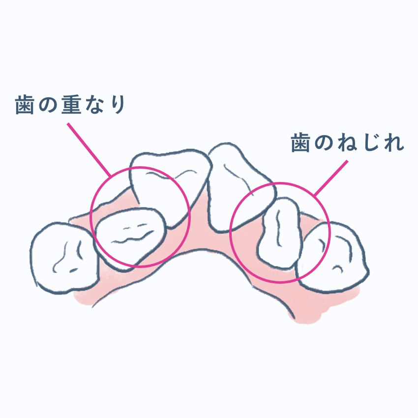 八重歯(やえば)