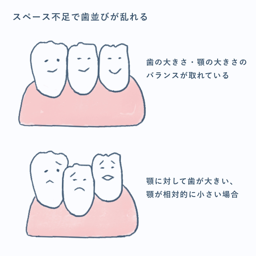 歯のならぶスペース不足