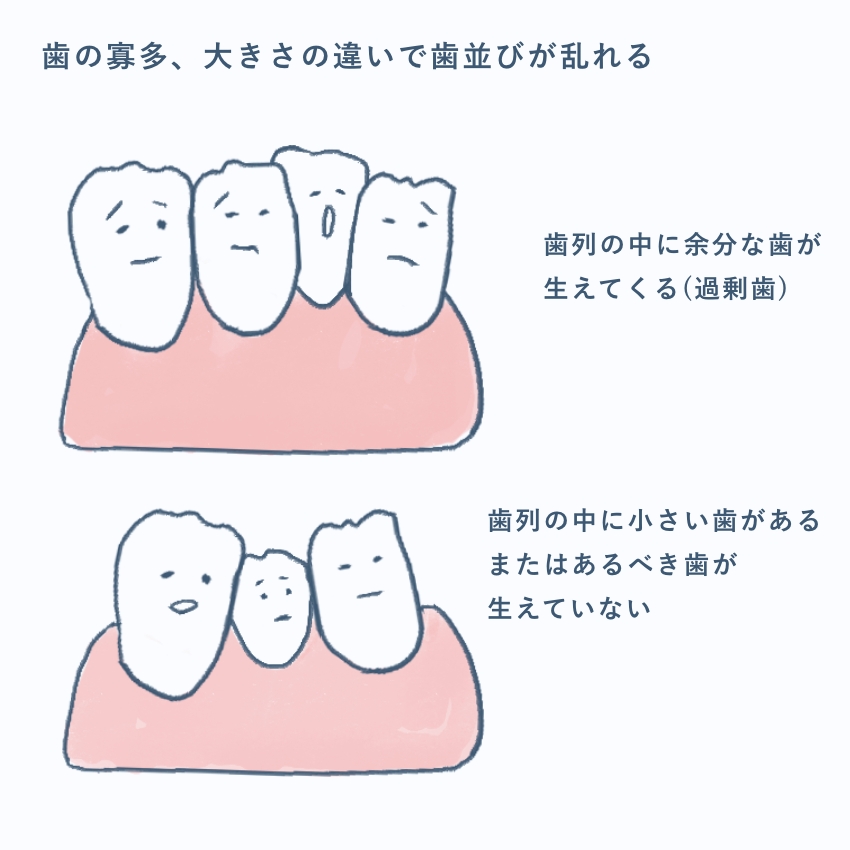 過剰歯・矮小歯