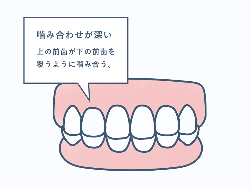 噛み合わせが深い