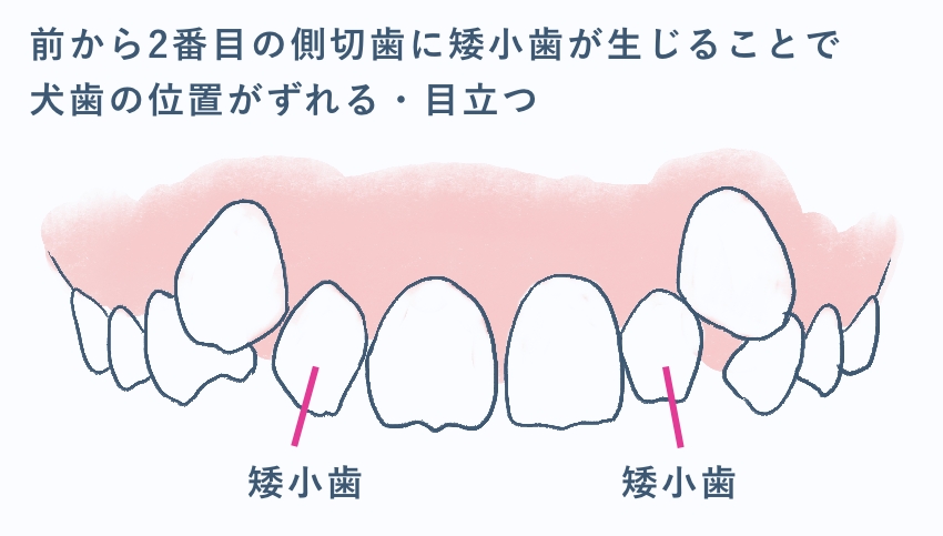 矮小歯があることで犬歯が目立つ