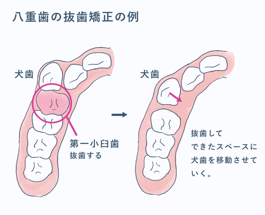 八重歯の抜歯矯正の例
