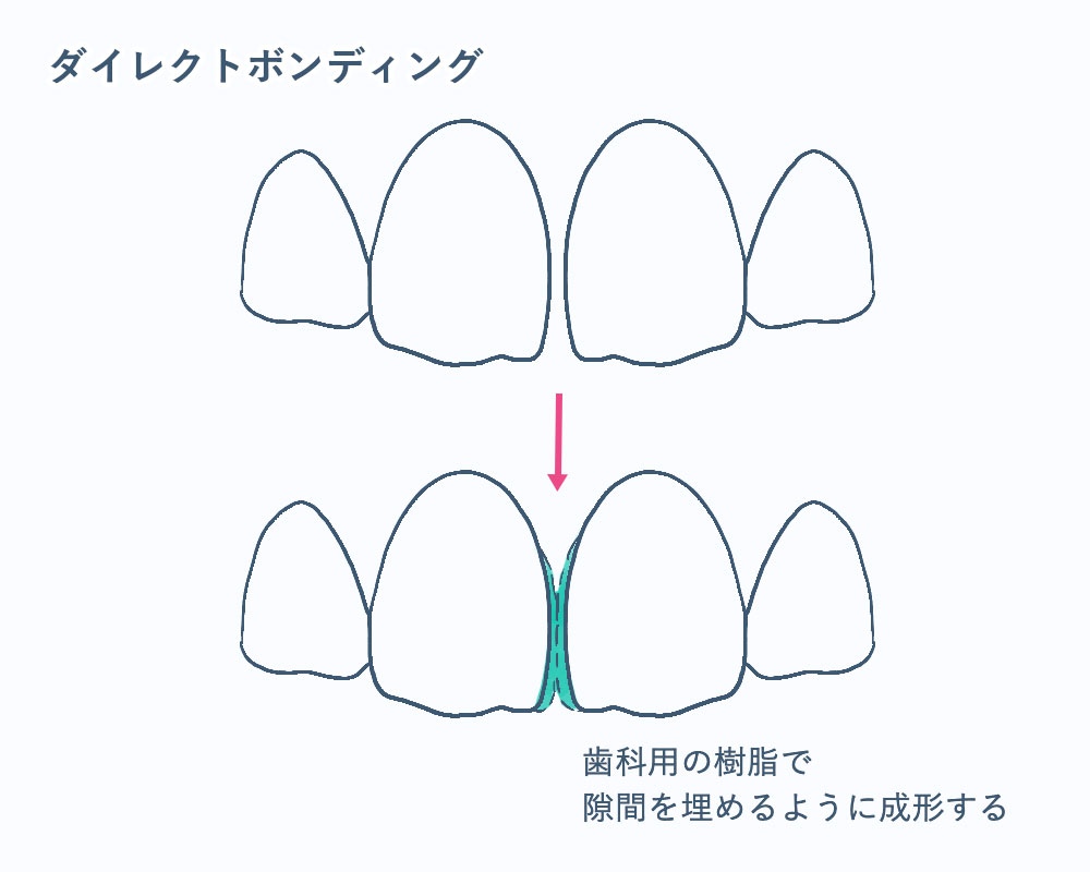 すきっ歯とダイレクトボンディング