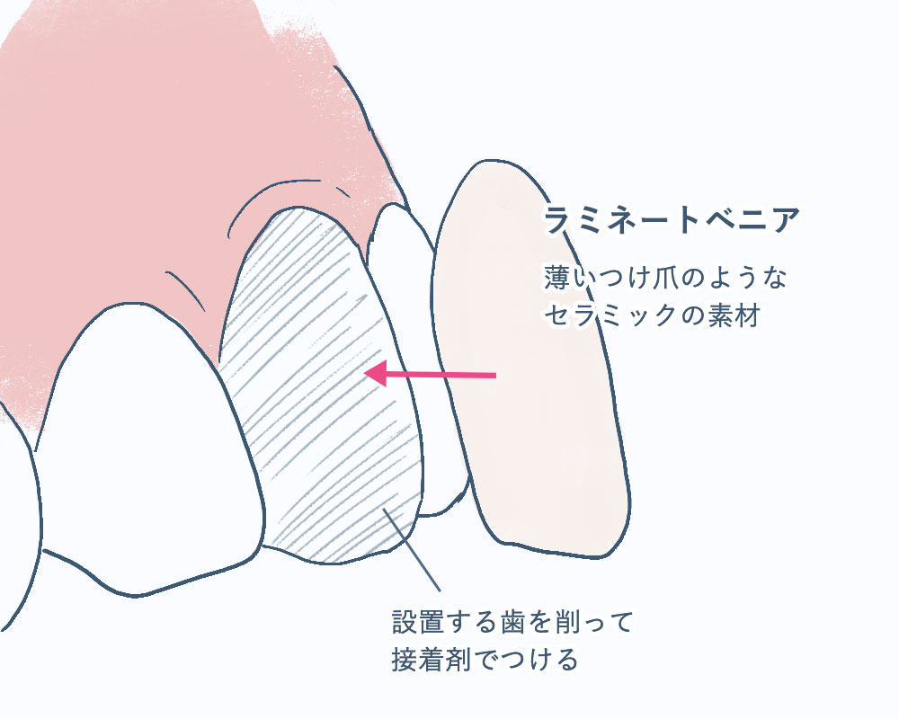 すきっ歯とラミネートベニア