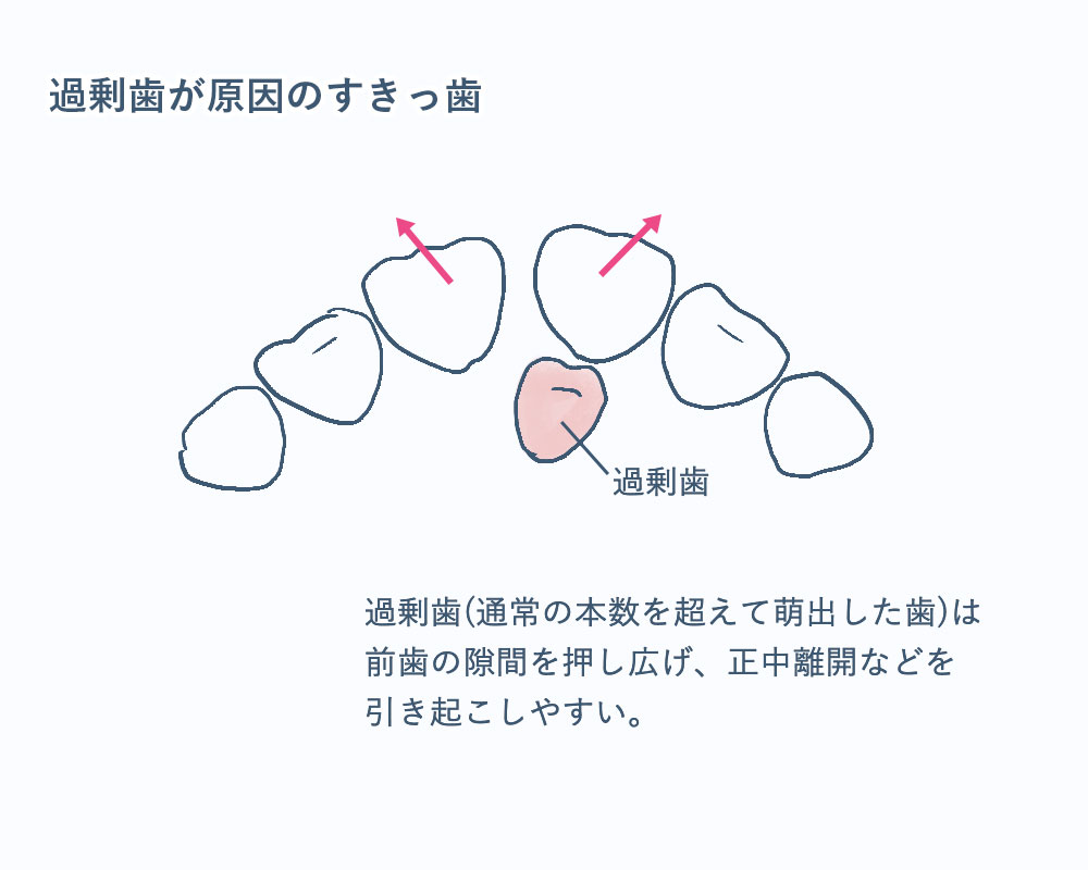 過剰歯とすきっ歯