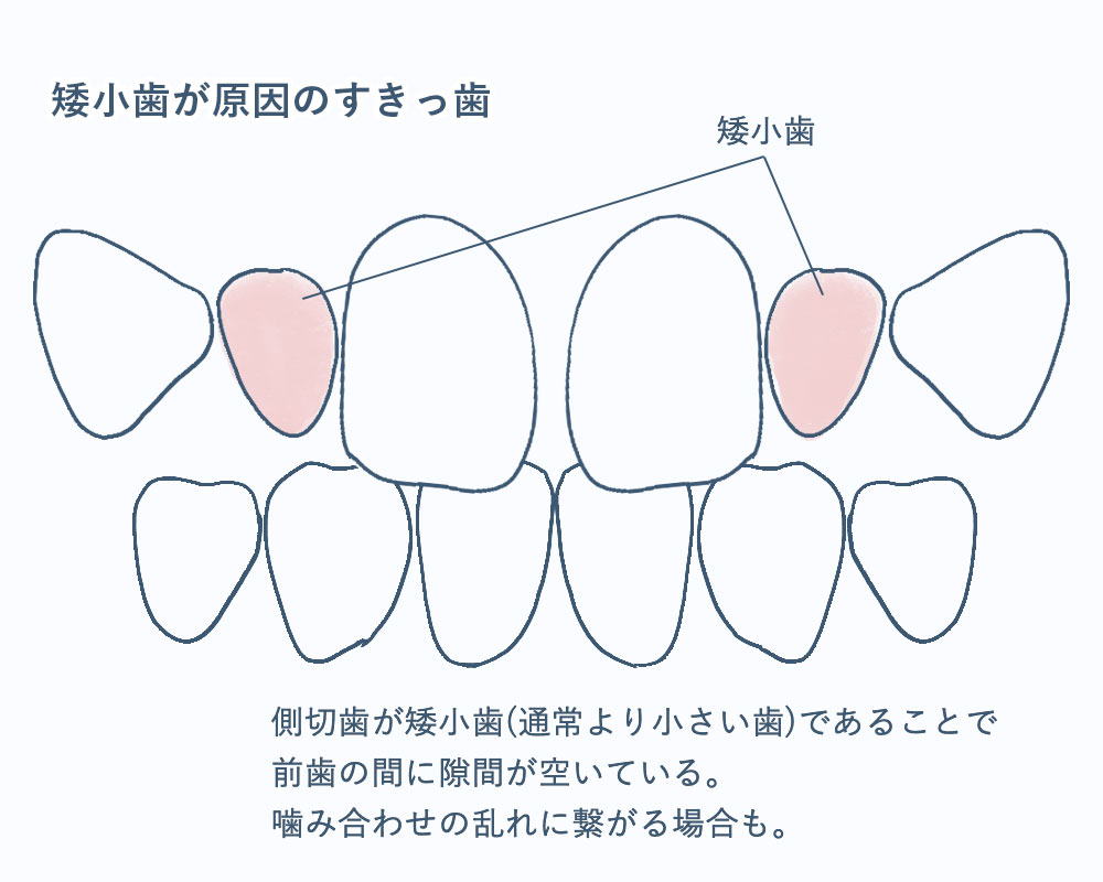 側切歯の矮小歯・欠損歯とすきっ歯