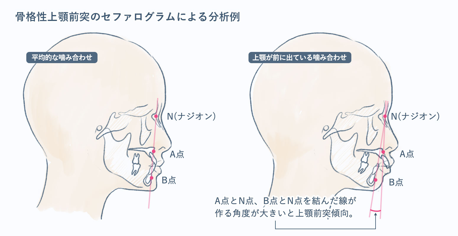 セファログラムで見た時の出っ歯、出っ歯の診断