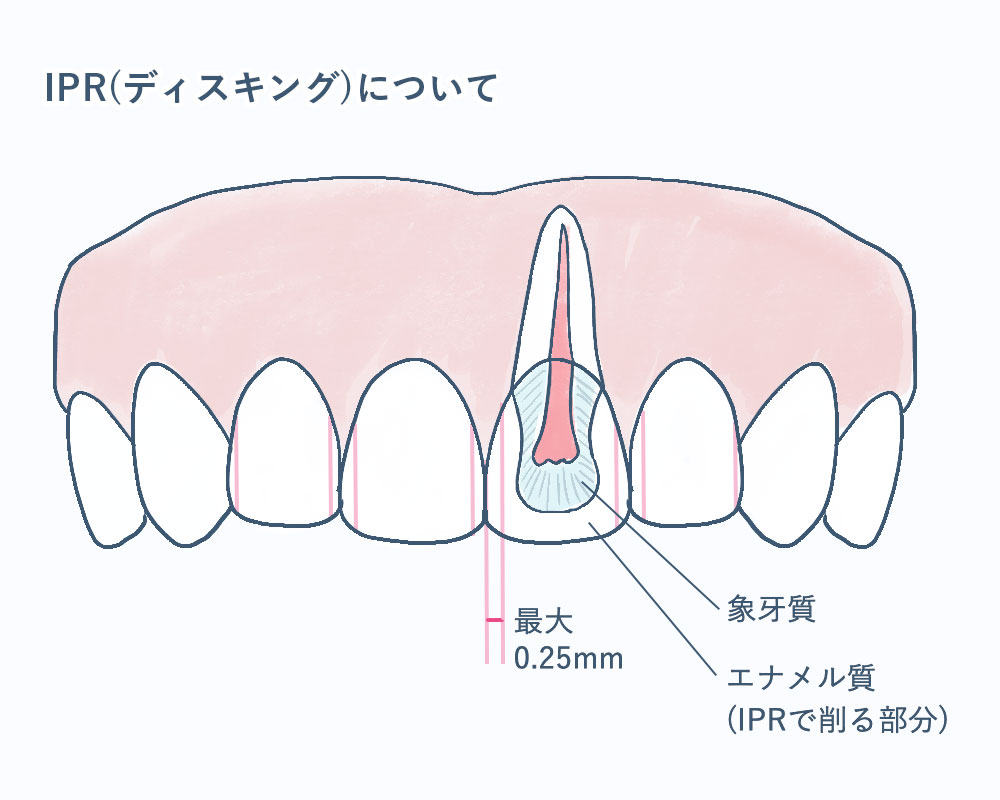 IPR・ディスキング