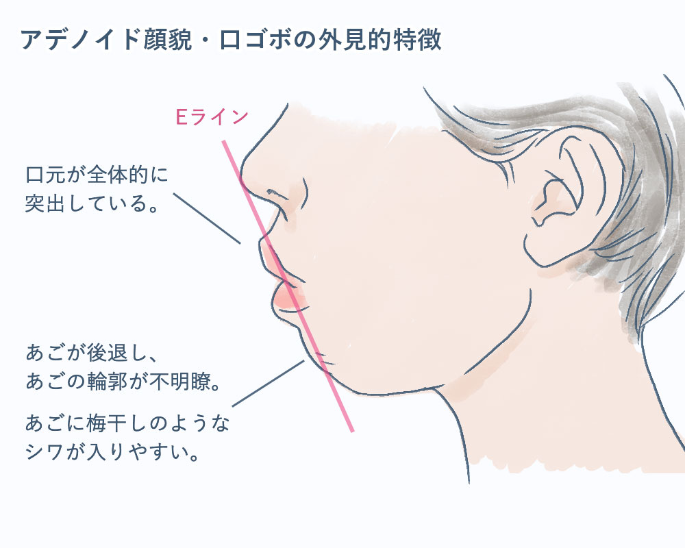 アデノイド顔貌・口ゴボの横顔