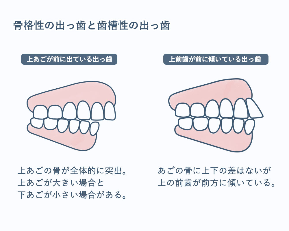 出っ歯の原因