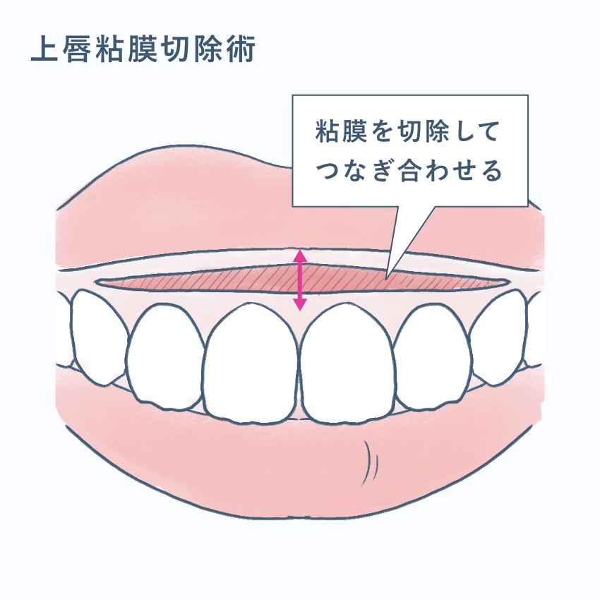上唇粘膜切除術