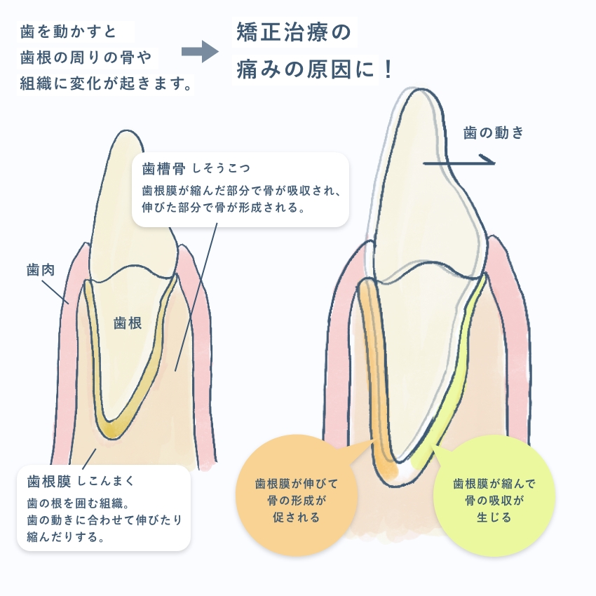 矯正治療で感じる痛み